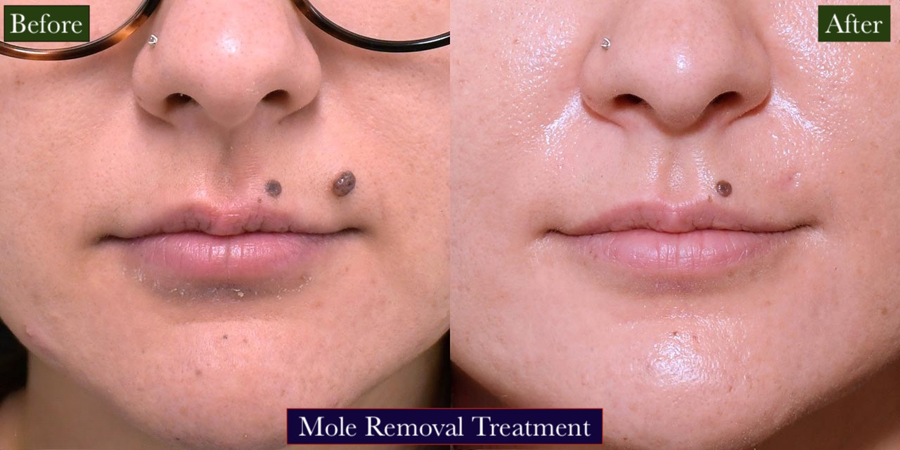 Mole Removal Treatment